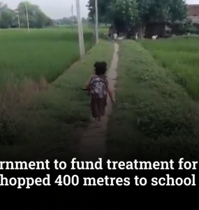 UP Government to fund treatment for 7-year-old who hopped 400 metres to school
